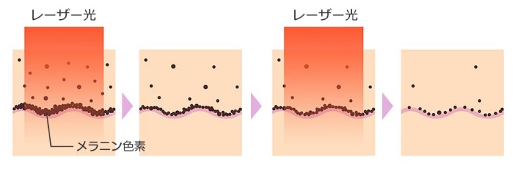 レーザートーニング